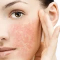 علت اگزمای پوستی چیست ؟